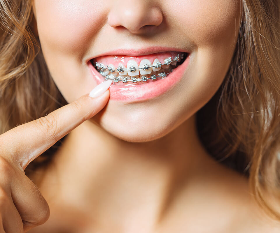When do you need braces?